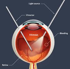vitrectomy-660x658