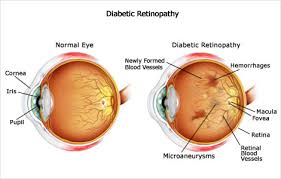 diabetic-retinopathy2